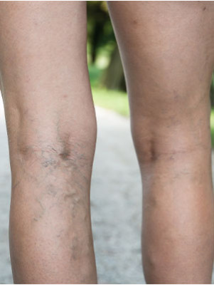 Sclerotherapy Leg Vein Injections
