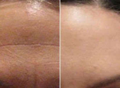 Forehead Combination Treatment Filler And Anti Wrinle Injections Thumb 1