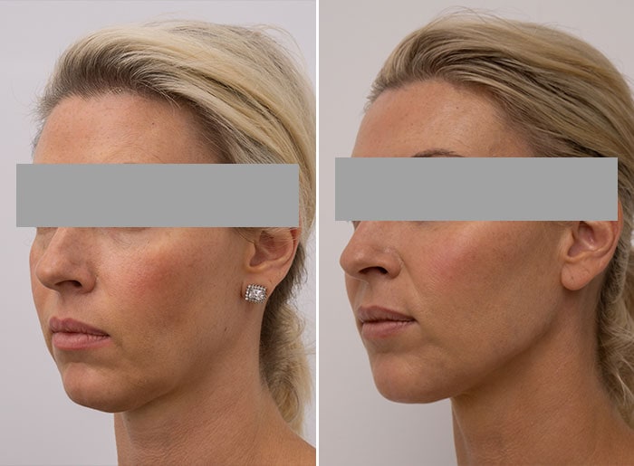 What's the Best Treatment for Sagging Jowls - El Paso Cosmetic Surgery