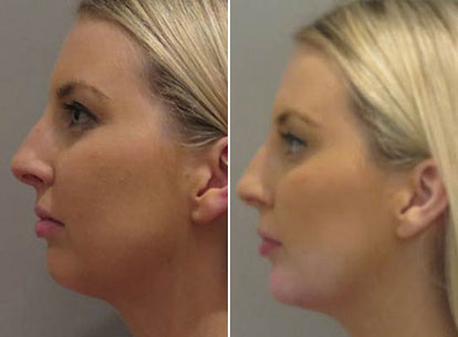 Thumb Chin Filler Female Left Side