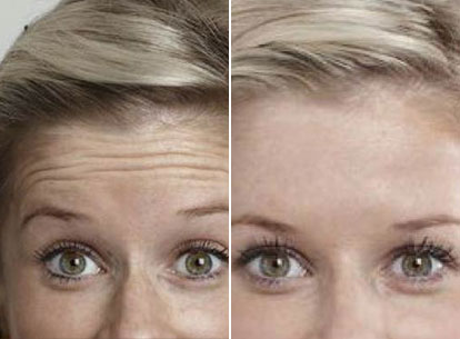 Thumb Forehead Anti Wrinkle Injections
