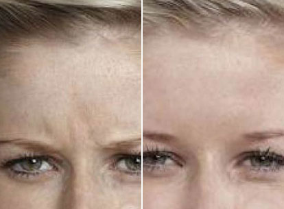 Thumb Frown Anti Wrinkle (1)