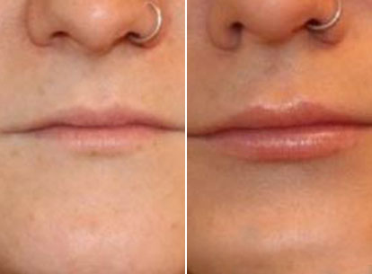 Thumb Lip Filler 2 (1)